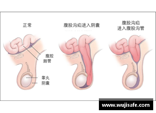 腹股沟疝球员的治疗与预防措施